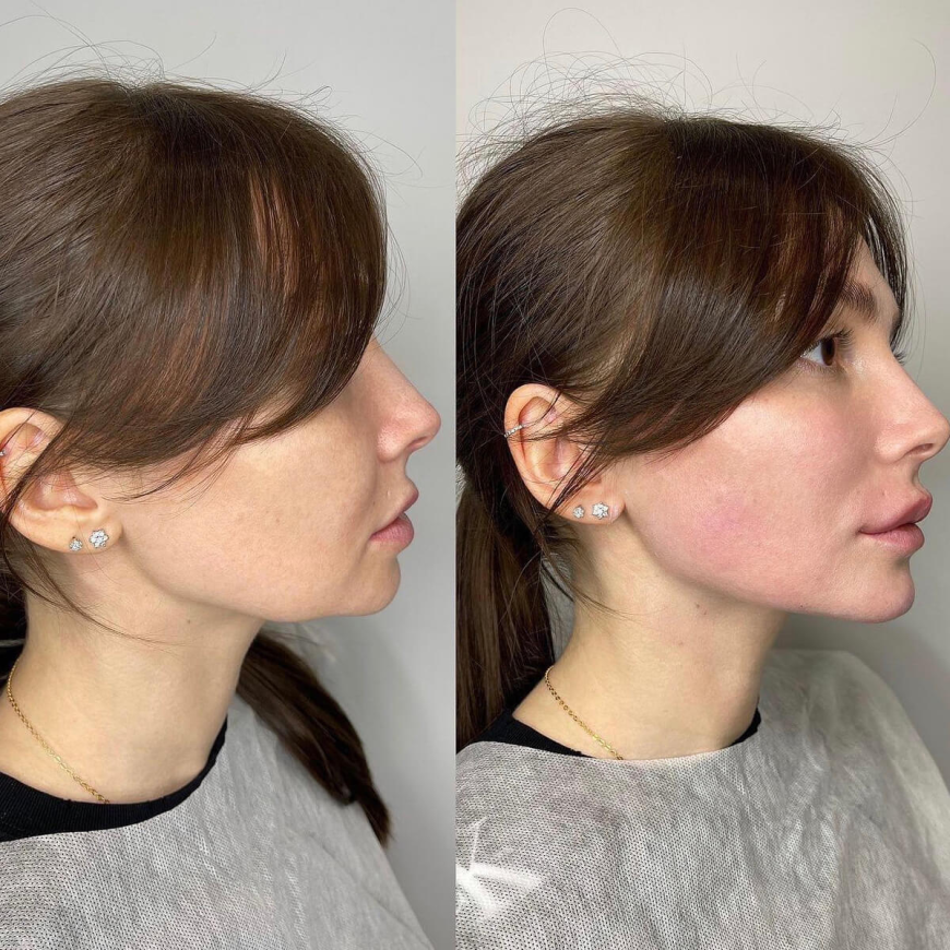 Improve Facial Definition With Jawline Contouring in Islamabad