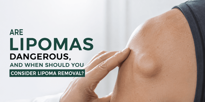 Are Lipomas Dangerous and When Should You Remove Them?
