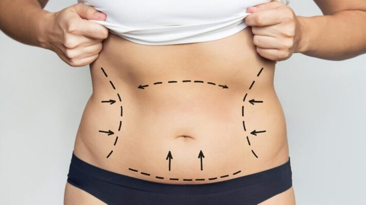 Best Liposuction Surgeon in Dubai: Understanding Techniques for Stubborn Fat