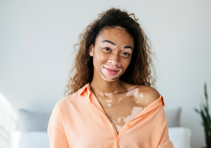 Homeopathy and Vitiligo: A Functional Approach to Skin Wellness