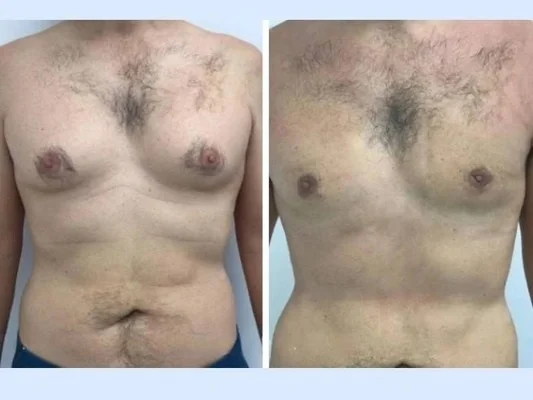 Gynecomastia in Dubai: What Makes Treatment Planning Important