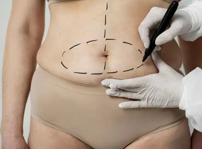 Tummy Tuck in Dubai After Pregnancy: Can Abdominoplasty Restore Your Abdomen?