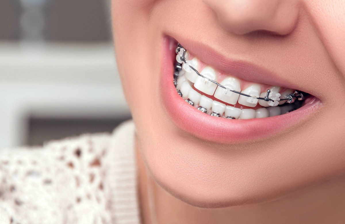 How Do Dental Braces Straighten Teeth? A Complete Guide