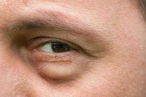 Is It Swelling or an Under-Eye Bag? Understanding the Difference