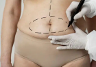 Tummy Tuck in Dubai After Pregnancy: Can Abdominoplasty Restore Your Abdomen?