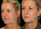 Sculptra Fillers Treatment in Dubai and Evolution of Injectable Aesthetics