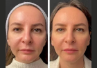 Mesotherapy Treatments in Dubai: Fine Lines and Wrinkles
