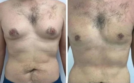 Gynecomastia in Dubai: What Makes Treatment Planning Important