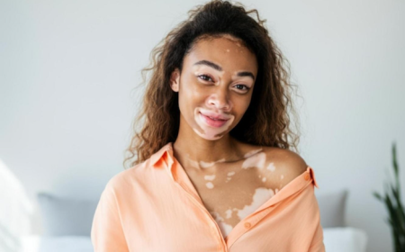 Homeopathy and Vitiligo: A Functional Approach to Skin Wellness