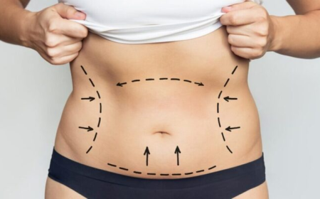 Best Liposuction Surgeon in Dubai: Understanding Techniques for Stubborn Fat