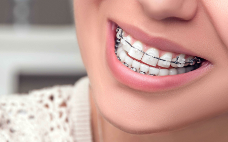 How Do Dental Braces Straighten Teeth? A Complete Guide