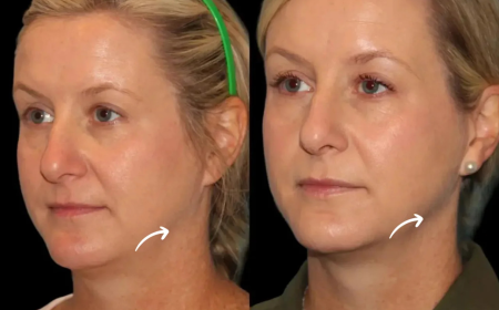 Sculptra Fillers Treatment in Dubai and Evolution of Injectable Aesthetics