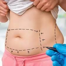 How to Find a Qualified Provider for Liposuction in Dubai