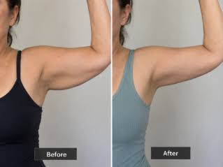 Arm Lift Surgery in Dubai for Loose Skin