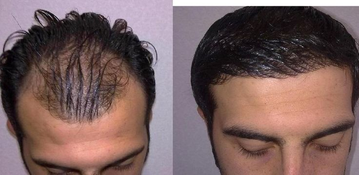 FUE Hair Transplant in Dubai: What to Expect
