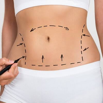 Liposuction Surgery in Dubai: Recovery Tips