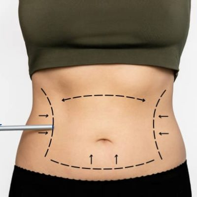How Tajmeels Clinic Helps Patients Prepare for Liposuction in Dubai