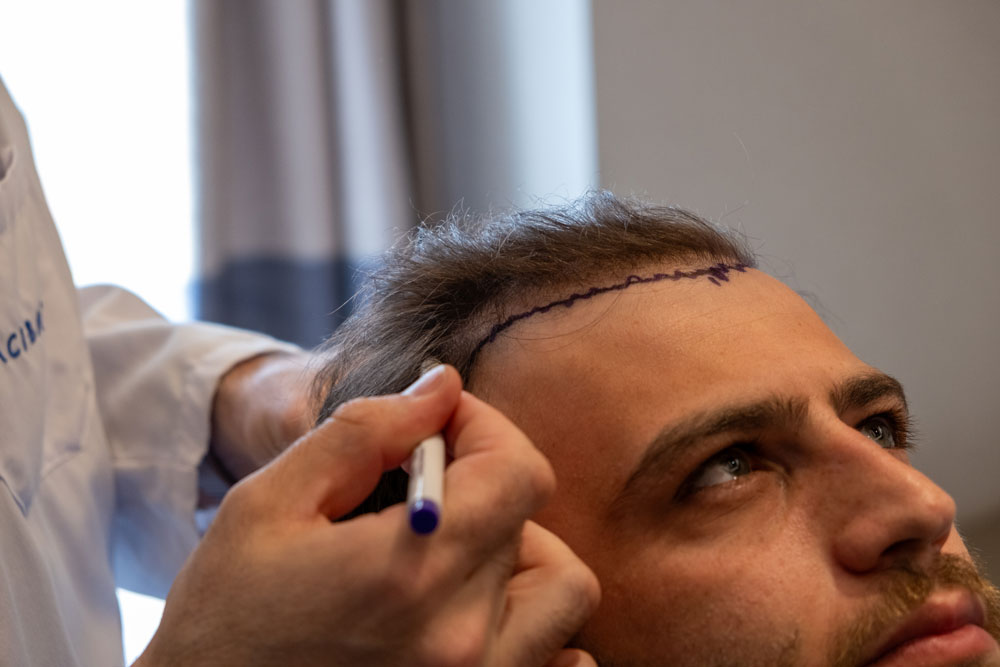 Hair Transplant Cost in Dubai: A Complete Guide