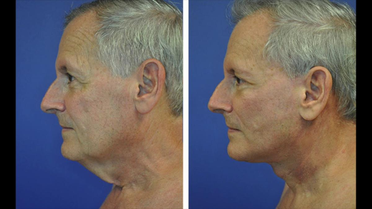 Neck Lift Surgery in Dubai: Benefits and Results