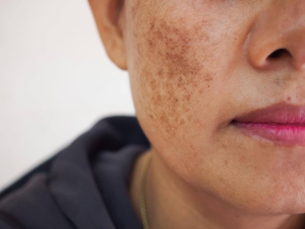 Skin Pigmentation in Dubai: Best Treatment Options