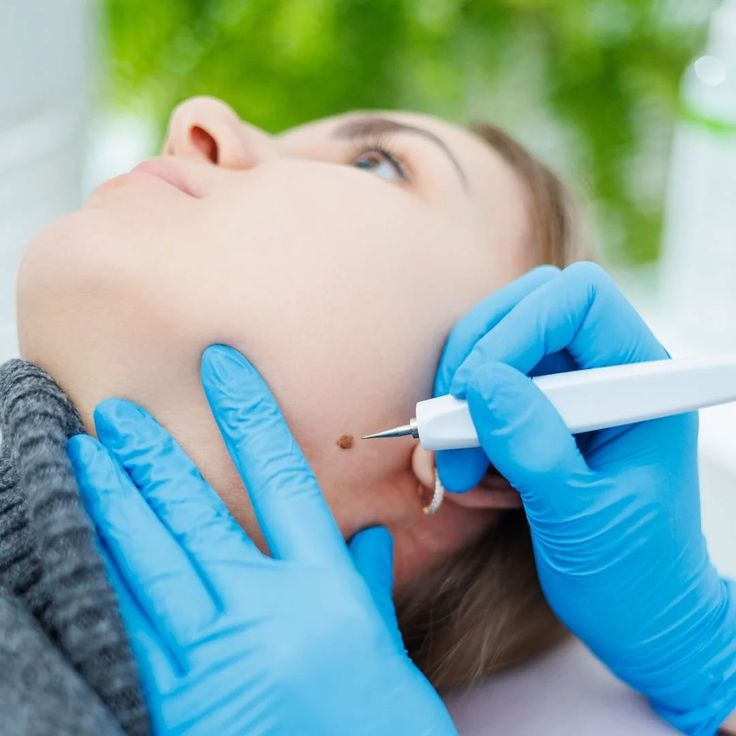 Mole Removal in Dubai: Medical vs Cosmetic Reasons