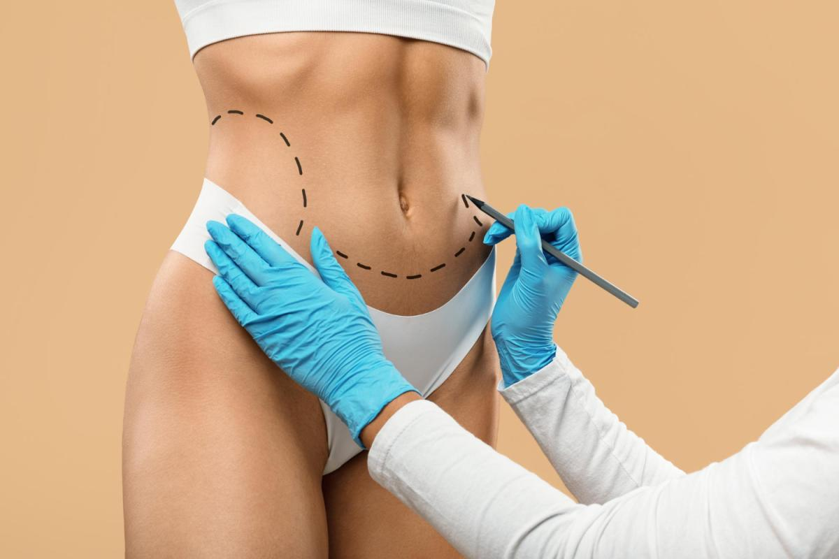 Liposuction Surgery in Dubai: A Complete Guide