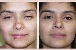How Tajmeels Clinic Helps Patients Understand Mole Removal Options