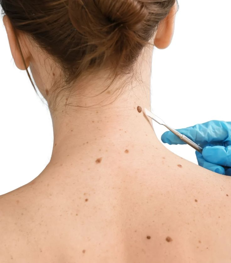 Mole Removal in Dubai: Signs You Should Not Ignore
