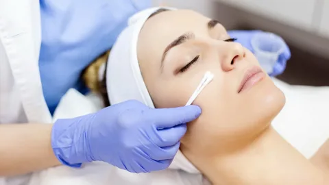 TCA Peel in Dubai: Is It Right for Melasma?