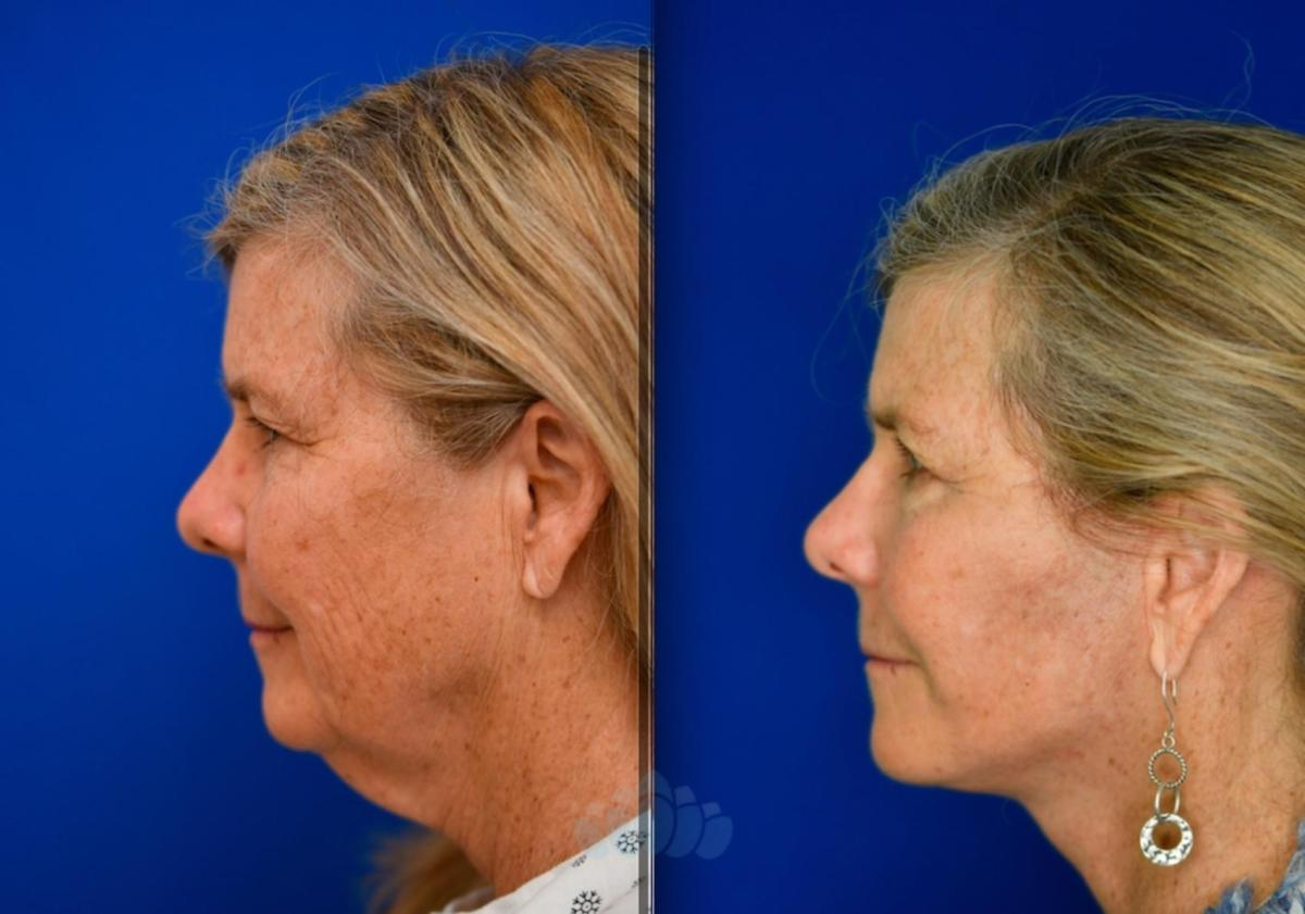 Neck Lift Surgery in Dubai: What to Expect