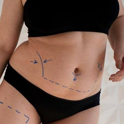 How Long Does Abdominal Tightness Last After Tummy Tuck Surgery?