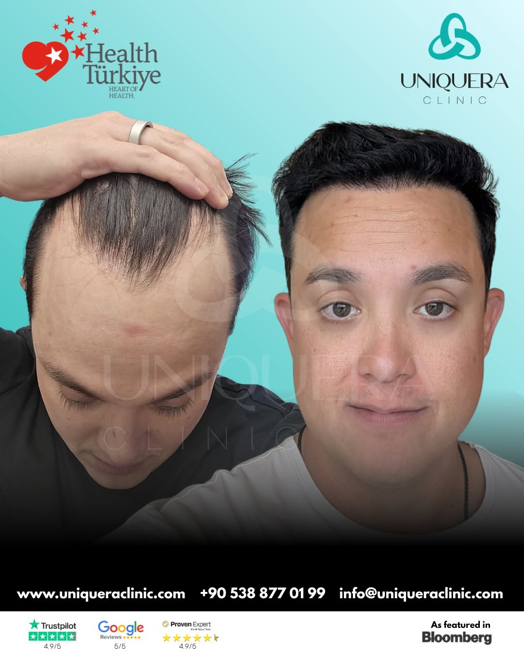 Understanding Diffuse Thinning Hair Transplant: What You Need to Know