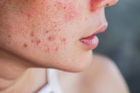 Why Individual Skin Assessment Matters Before Pimple Treatment at Tajmeels Clinic