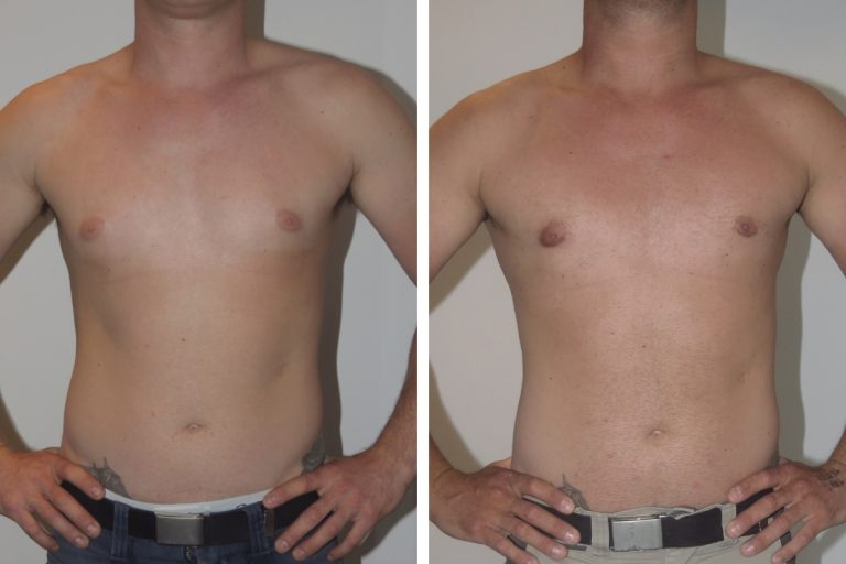 Where Can You Get a Medical Assessment for Gynaecomastia Surgery in Dubai?