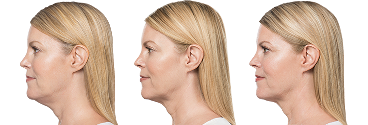 Benefits of Kybella Treatment for Double chin in Dubai