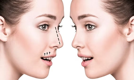 Why Is Nasal Tip Support Important When Planning Rhinoplasty?