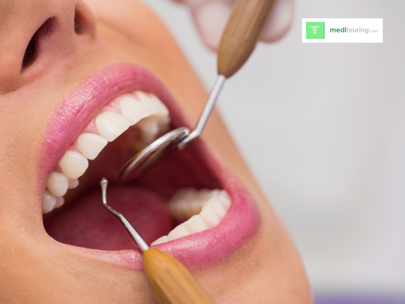 Dental Implant Costs Abroad: What Is Included in Your Treatment Package?