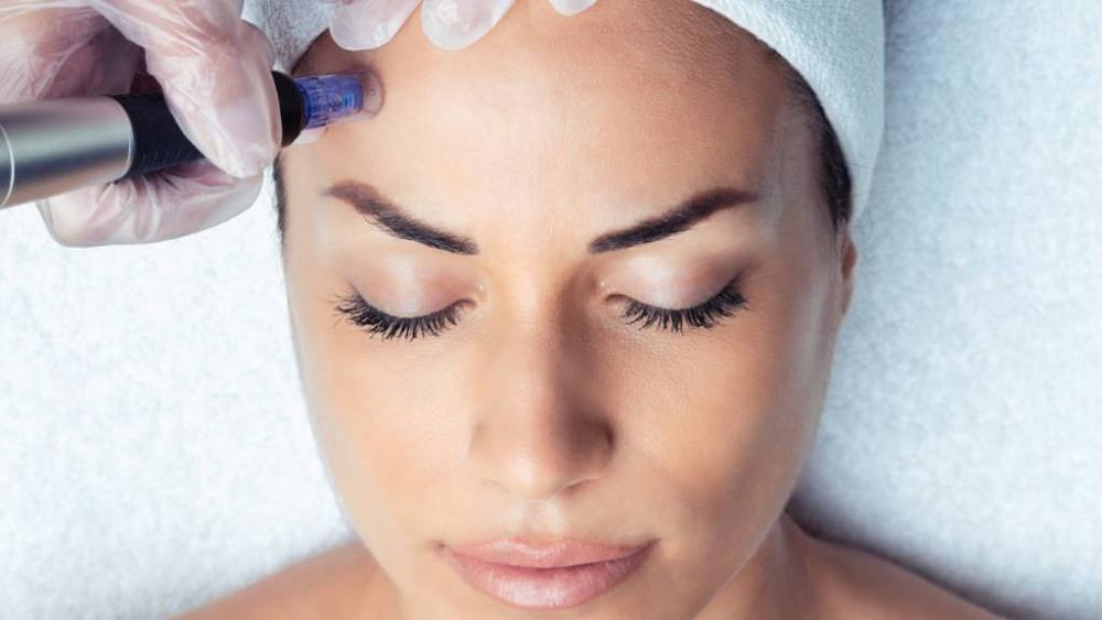 Microneedling Acupuncture in Oakland: Faster Skin Results