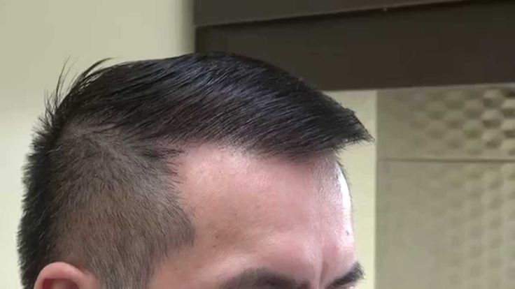 FUE Hair Transplant in Dubai: What to Expect