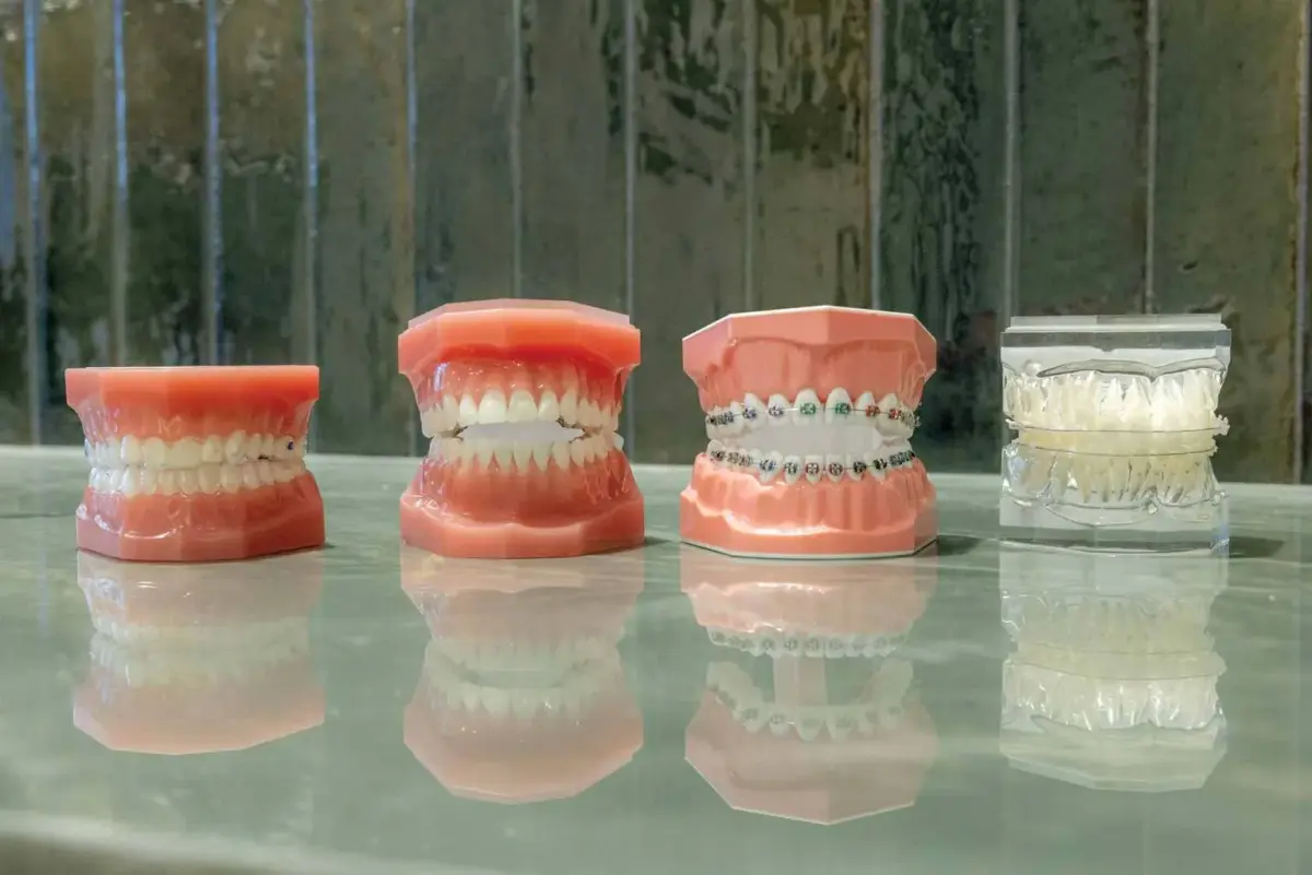 A Practical Guide to Venice Braces for Teens and Adults for Achieving More Beautiful Smile