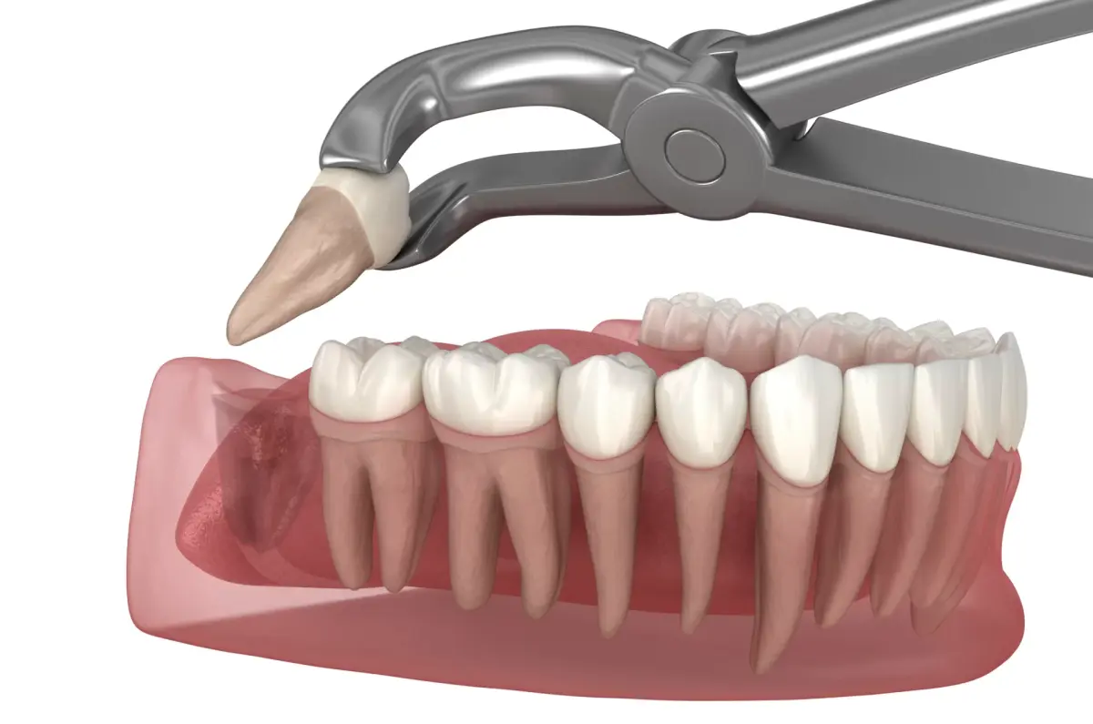 Understanding Wisdom Teeth Removal and Urgent Dental Care in League City