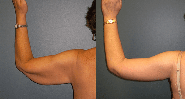 Arm Lift Surgery in Dubai for Toned Upper Arms