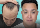 Understanding Diffuse Thinning Hair Transplant: What You Need to Know