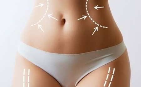 Liposuction Surgery in Dubai: Benefits and Risks