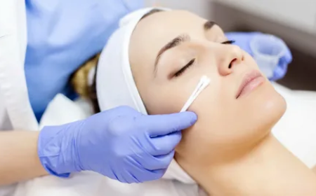 TCA Peel in Dubai: Is It Right for Melasma?
