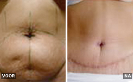 Why Won't Your C-Section Shelf Go Away? What a Mommy Makeover Can Actually Do in 2026