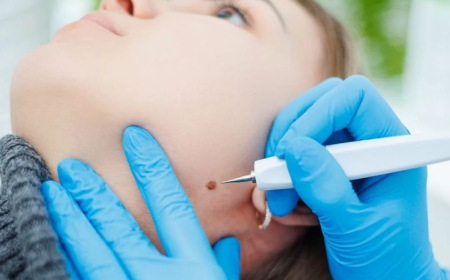 Mole Removal in Dubai: Medical vs Cosmetic Reasons