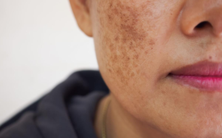 Skin Pigmentation in Dubai: Best Treatment Options