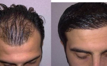 FUE Hair Transplant in Dubai: What to Expect