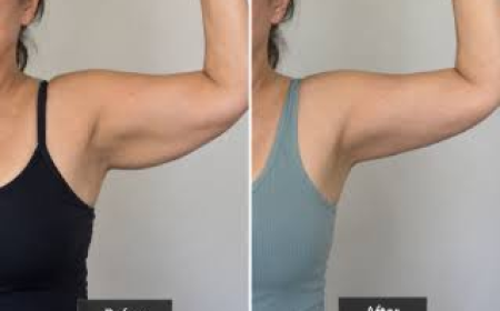 Arm Lift Surgery in Dubai for Loose Skin
